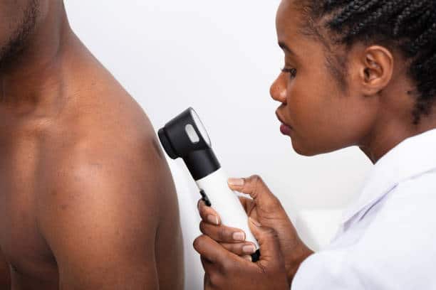 melanoma