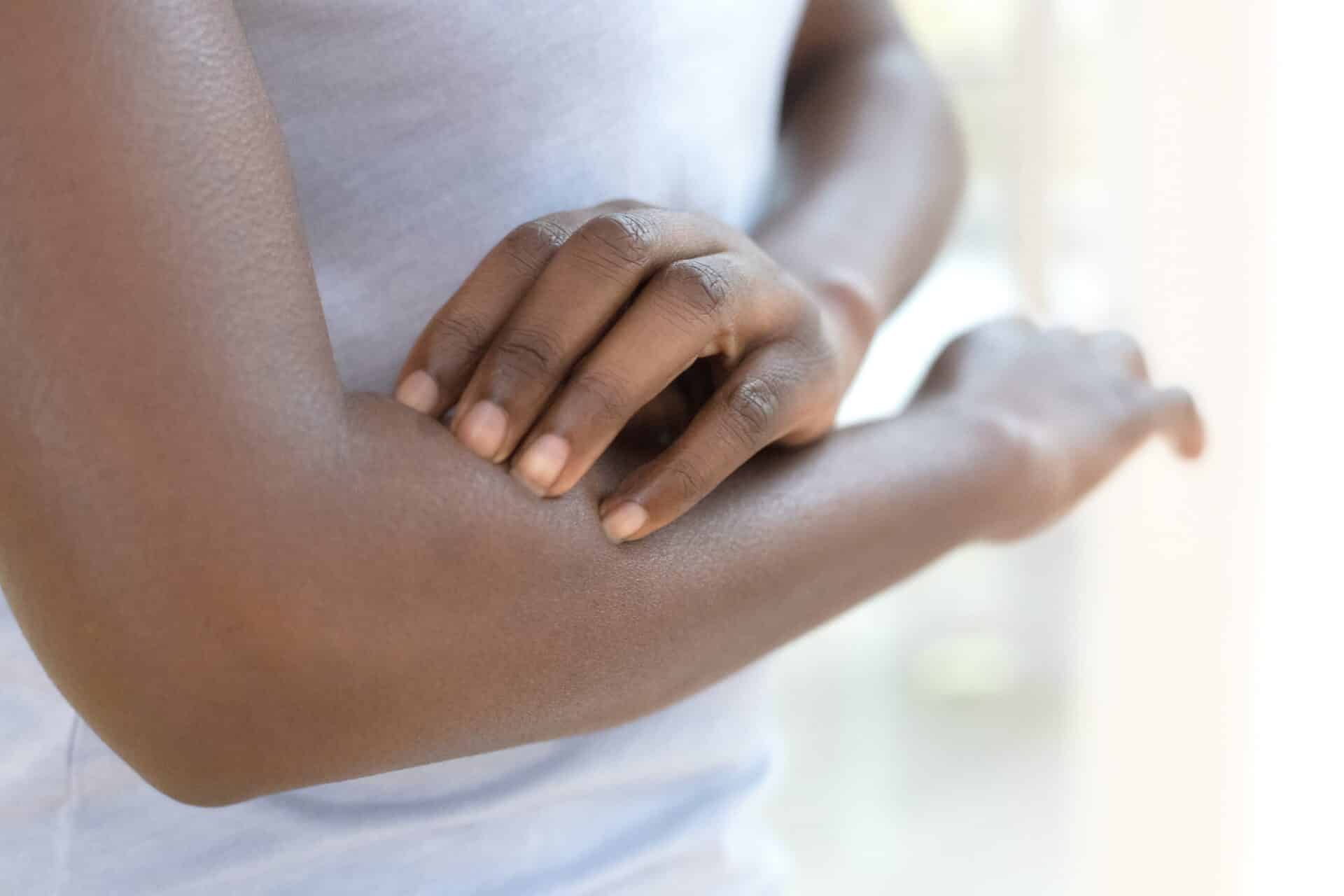 Climatic Hazards Affecting People of Color Linked to Aggravation of Atopic Dermatitis