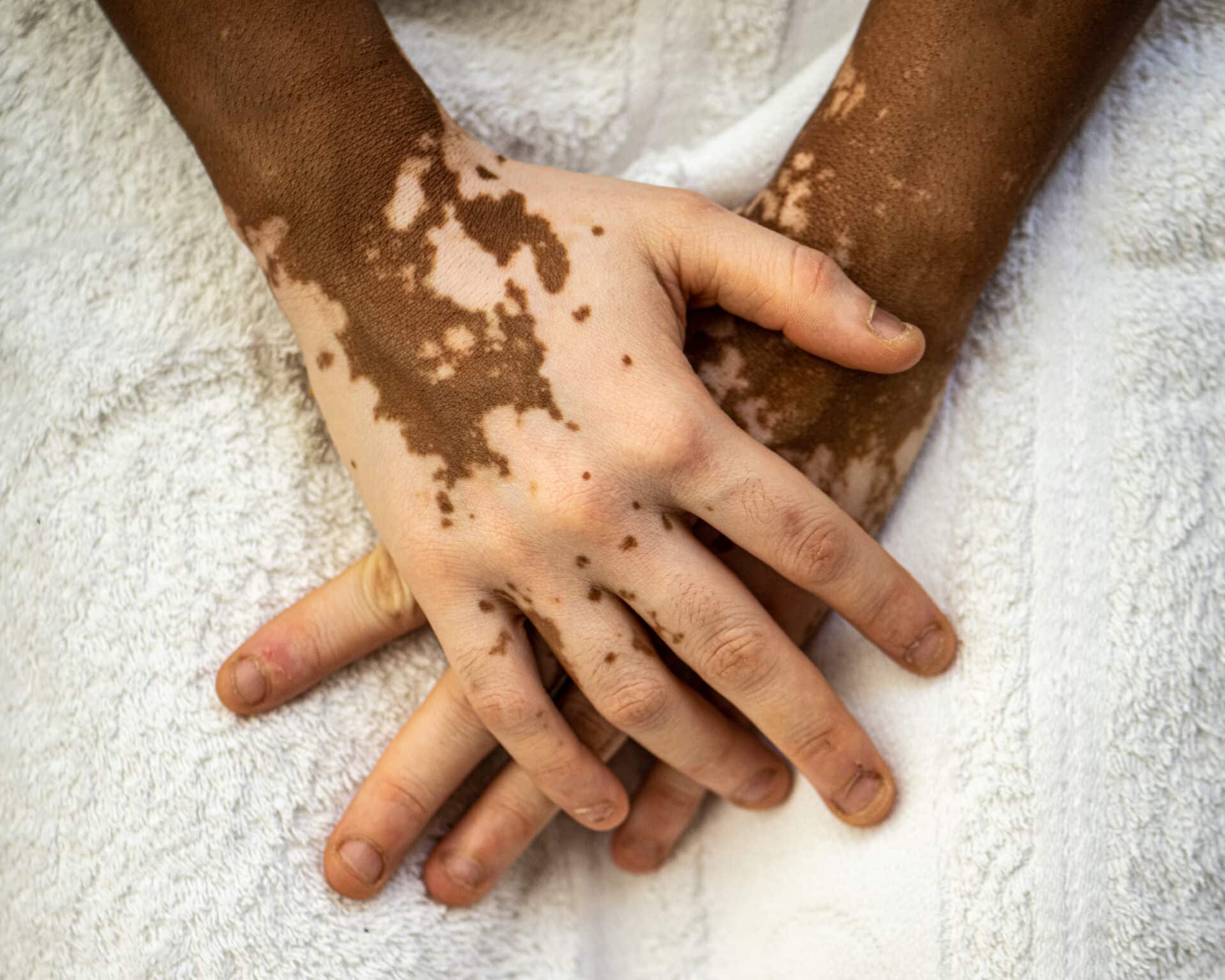 Vitiligo Patients Have Significantly Higher Health Care Costs