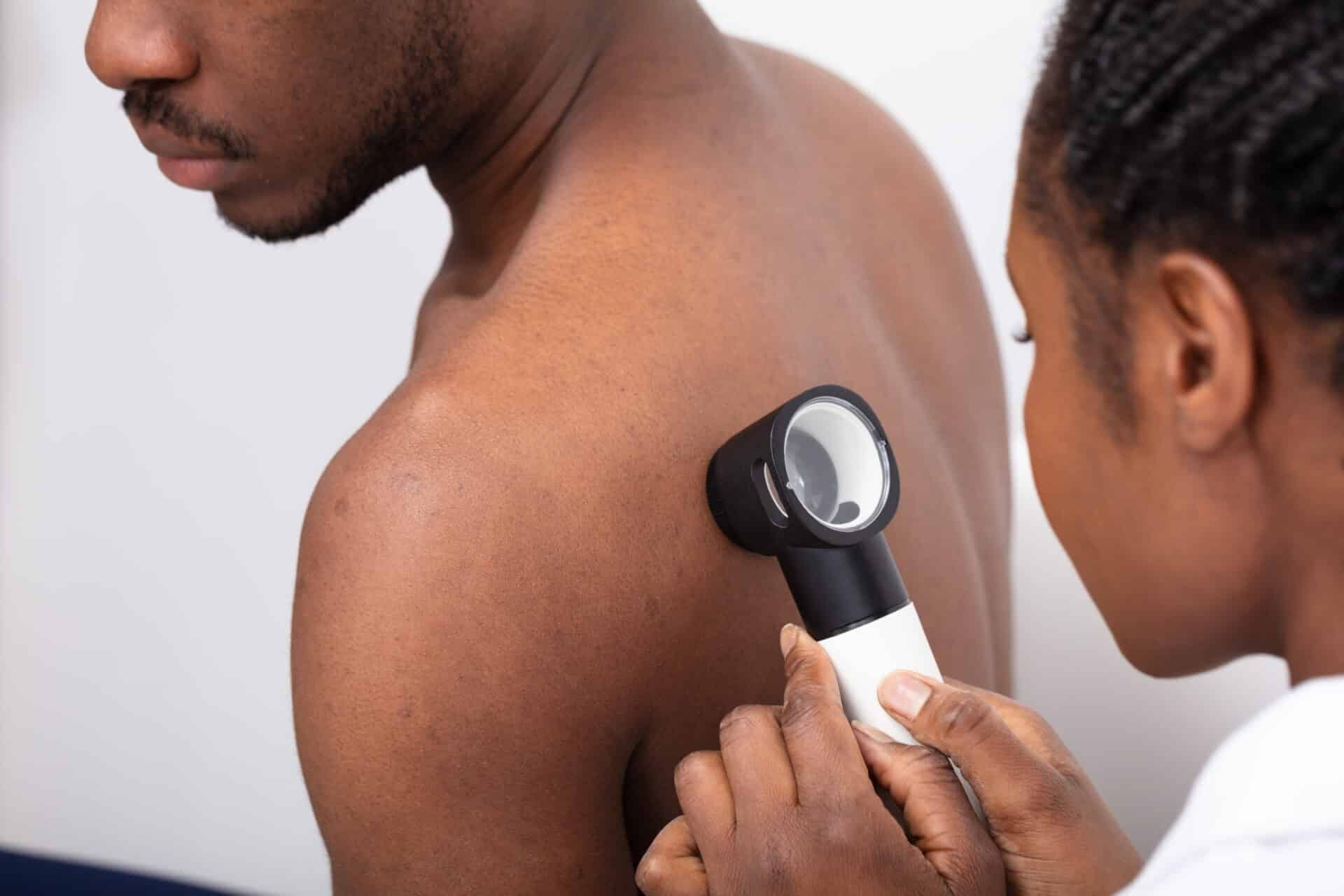 Black Melanoma Patients Tend to Show Advanced Disease
