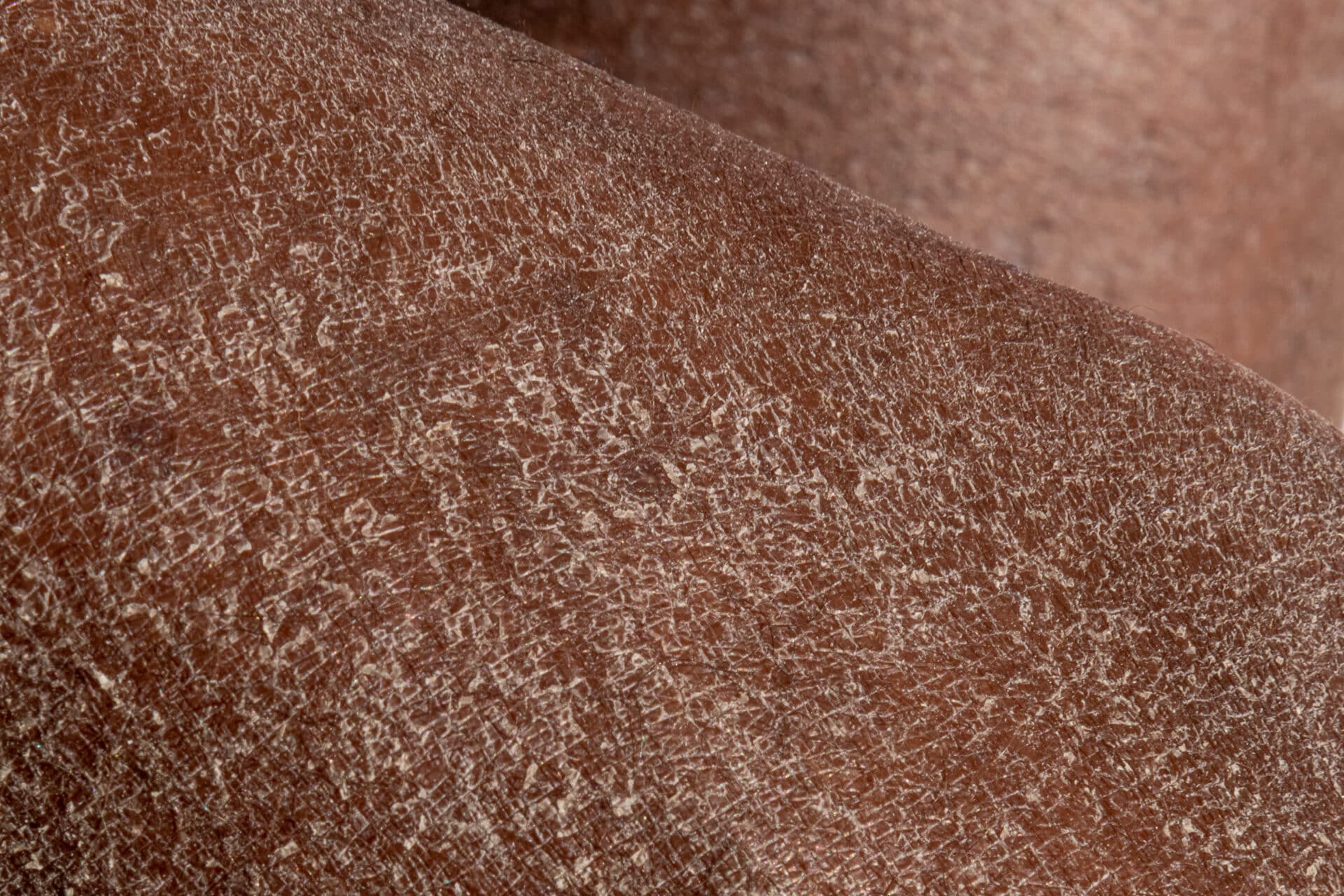 Eczema: What It Is and How to Treat It in Black Patients