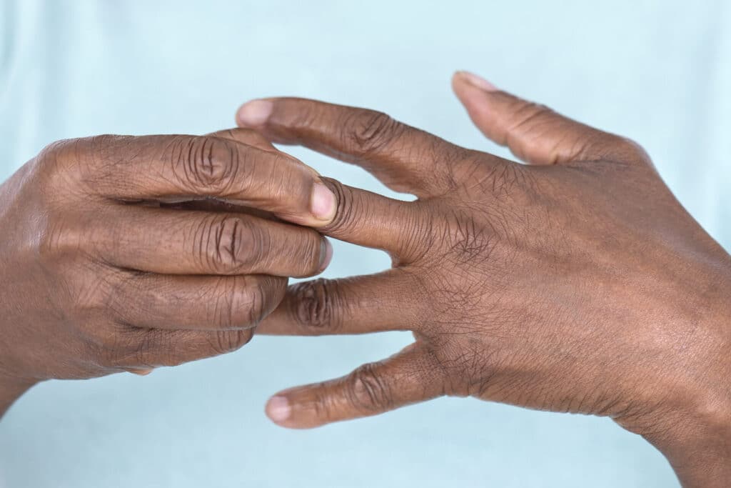 Rheumatoid arthritis, RA, autoimmune disease, global health, healthcare professionals, DALYs, disability-adjusted life years, chronic illness, health disparities, Black patients, health equity, systemic racism, access to care, treatment outcomes, early diagnosis, biologic therapies, public health, preventive care, clinical research, epidemiology, patient care, chronic pain, inflammation, joint pain, disease management, socioeconomic factors.