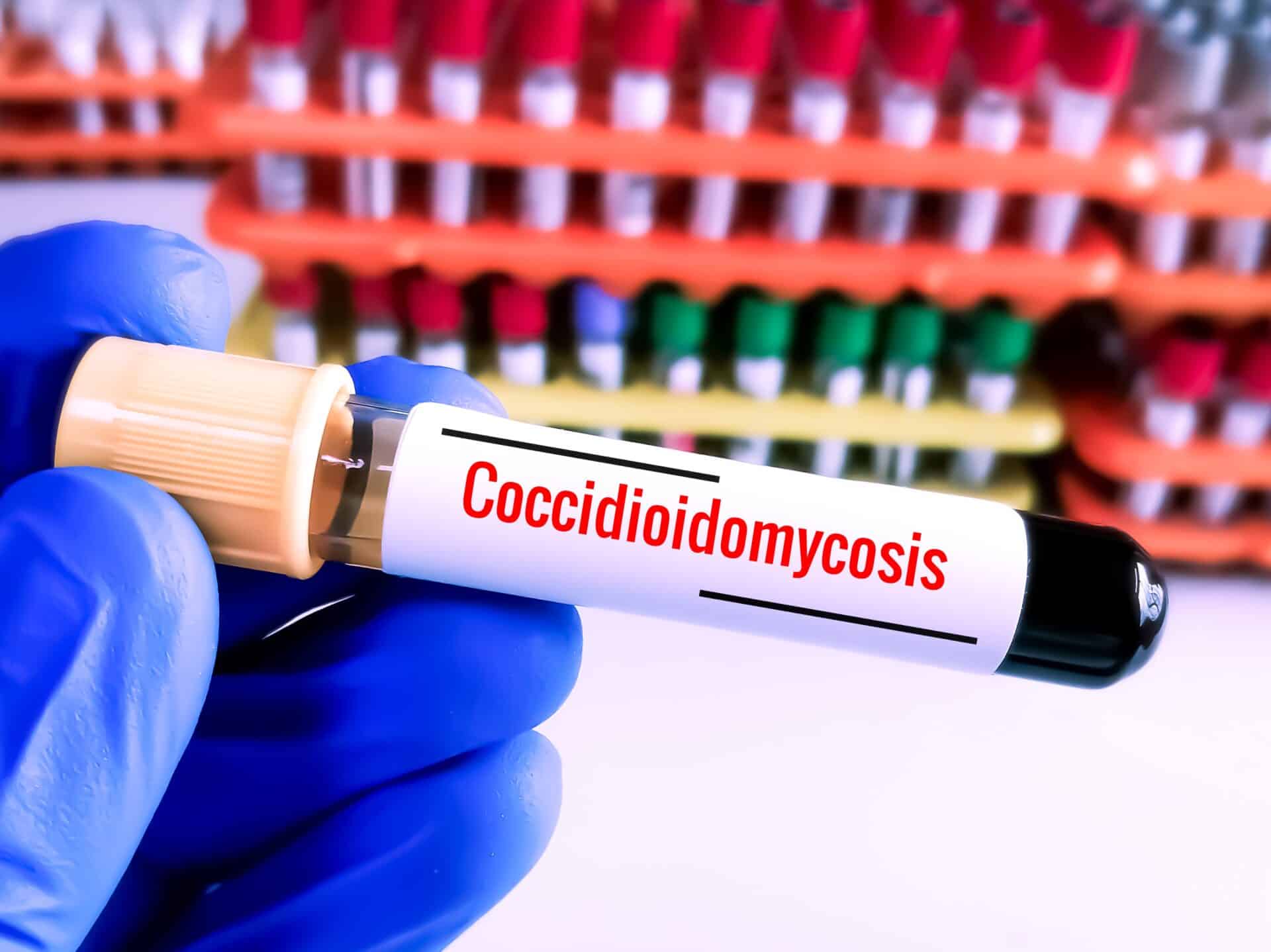Coccidioidomycosis, Coccidioides immitis or Coccidioides posadasii. Valley fever, California fever, valley fever symptoms, valley fever disease, valley fever treatment, what is valley fever, valley fever diagnosis