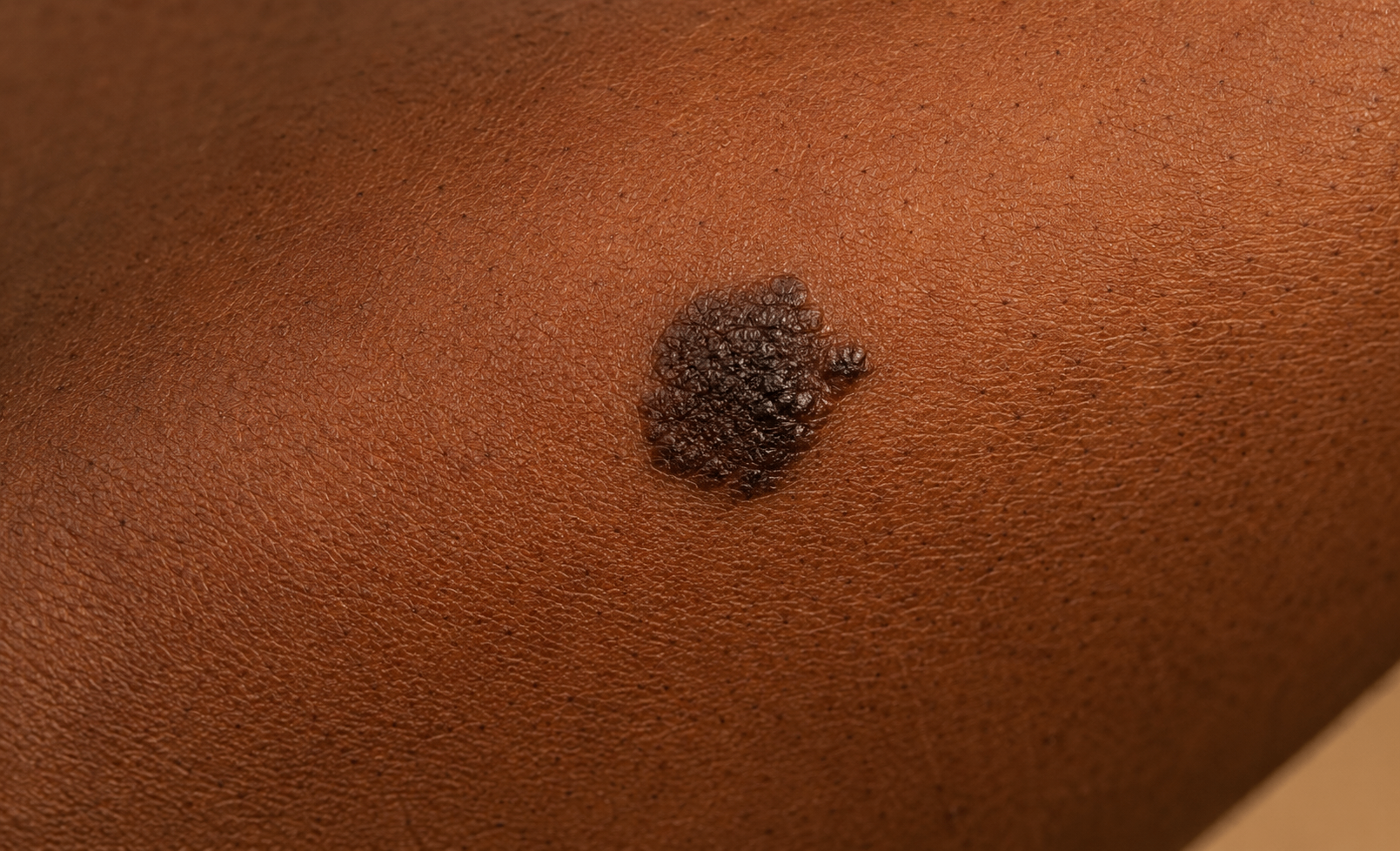 melanoma