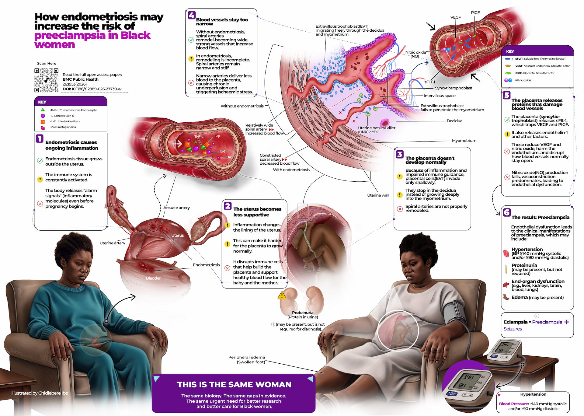 endometriosis